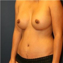 Mommy Makeover After Photo by Steve Laverson, MD, FACS; Rancho Santa Fe, CA - Case 36818
