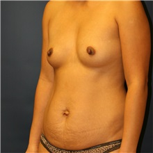 Mommy Makeover Before Photo by Steve Laverson, MD, FACS; Rancho Santa Fe, CA - Case 36818