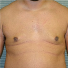 Male Breast Reduction After Photo by Jonathan Weinrach, MD; ,  - Case 36843