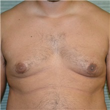 Male Breast Reduction Before Photo by Jonathan Weinrach, MD; ,  - Case 36843