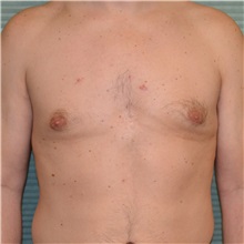 Male Breast Reduction After Photo by Jonathan Weinrach, MD; ,  - Case 36844