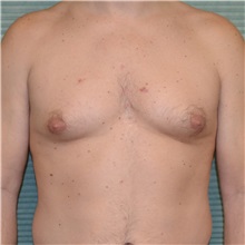Male Breast Reduction Before Photo by Jonathan Weinrach, MD; ,  - Case 36844