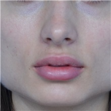 Lip Augmentation/Enhancement After Photo by Jonathan Weinrach, MD; ,  - Case 36863