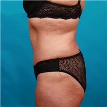 Tummy Tuck After Photo by Michael Bogdan, MD, MBA, FACS; Grapevine, TX - Case 36912