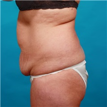 Tummy Tuck Before Photo by Michael Bogdan, MD, MBA, FACS; Grapevine, TX - Case 36912