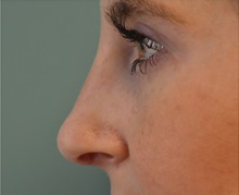 Rhinoplasty After Photo by Richard Kutz, MD, MPH, FACS; Westbrook, ME - Case 37317
