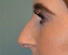Rhinoplasty Before Photo by Richard Kutz, MD, MPH, FACS; Westbrook, ME - Case 37317