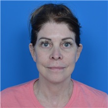 Facelift After Photo by Jonathan Weinrach, MD; ,  - Case 37466