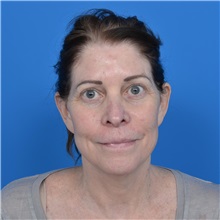 Facelift Before Photo by Jonathan Weinrach, MD; ,  - Case 37466