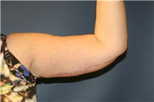 Arm Lift After Photo by Steve Laverson, MD, FACS; Rancho Santa Fe, CA - Case 37560