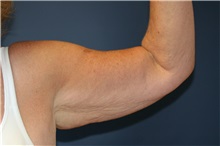 Arm Lift Before Photo by Steve Laverson, MD, FACS; Rancho Santa Fe, CA - Case 37560