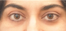 Eyelid Surgery After Photo by Keshav Magge, MD; Bethesda, MD - Case 37687