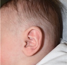 Ear Surgery After Photo by Rachel Ruotolo, MD; Garden City, NY - Case 37787