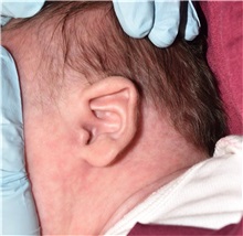 Ear Surgery Before Photo by Rachel Ruotolo, MD; Garden City, NY - Case 37787