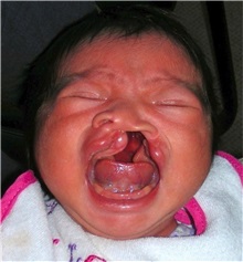 Cleft Lip and Palate Repair Before Photo by Rachel Ruotolo, MD; Garden City, NY - Case 37790