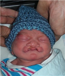 Cleft Lip and Palate Repair Before Photo by Rachel Ruotolo, MD; Garden City, NY - Case 37796