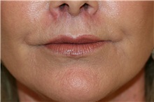 Lip Augmentation/Enhancement After Photo by Steve Laverson, MD, FACS; Rancho Santa Fe, CA - Case 38013