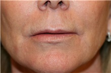 Lip Augmentation/Enhancement Before Photo by Steve Laverson, MD, FACS; Rancho Santa Fe, CA - Case 38013