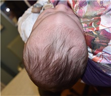 Craniosynostosis Before Photo by Rachel Ruotolo, MD; Garden City, NY - Case 38029