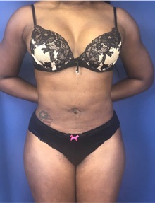 Liposuction After Photo by Mark Markarian, MD, MSPH, FACS; Wellesley, MA - Case 38064