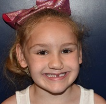Cleft Lip and Palate Repair After Photo by Rachel Ruotolo, MD; Garden City, NY - Case 38104