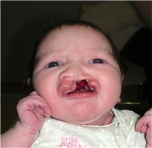 Cleft Lip and Palate Repair Before Photo by Rachel Ruotolo, MD; Garden City, NY - Case 38104