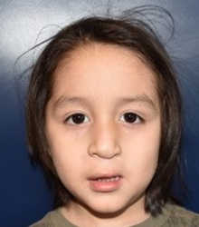 Cleft Lip and Palate Repair After Photo by Rachel Ruotolo, MD; Garden City, NY - Case 38133