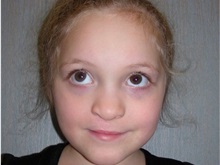 Cleft Lip and Palate Repair After Photo by Rachel Ruotolo, MD; Garden City, NY - Case 38141