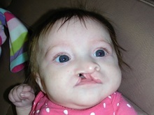 Cleft Lip and Palate Repair Before Photo by Rachel Ruotolo, MD; Garden City, NY - Case 38141