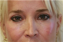 Eyelid Surgery After Photo by Steve Laverson, MD, FACS; Rancho Santa Fe, CA - Case 38283