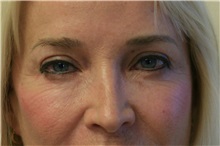 Eyelid Surgery Before Photo by Steve Laverson, MD, FACS; Rancho Santa Fe, CA - Case 38283