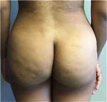Buttock Lift with Augmentation After Photo by Mariam Awada, MD, FACS; ,  - Case 38890