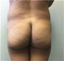 Buttock Lift with Augmentation Before Photo by Mariam Awada, MD, FACS; ,  - Case 38890