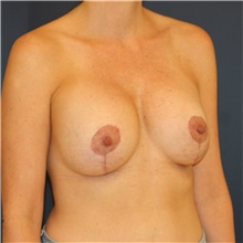 Breast Lift After Photo by Steve Laverson, MD, FACS; Rancho Santa Fe, CA - Case 39105