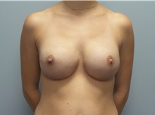 Breast Reconstruction After Photo by C. Andrew Salzberg, MD; Vero Beach, FL - Case 39376