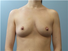Breast Reconstruction Before Photo by C. Andrew Salzberg, MD; Vero Beach, FL - Case 39376