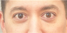 Eyelid Surgery After Photo by Keshav Magge, MD; Bethesda, MD - Case 39403