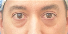Eyelid Surgery Before Photo by Keshav Magge, MD; Bethesda, MD - Case 39403