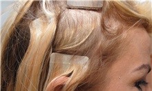 Hair Transplant After Photo by Ellen Mahony, MD; Westport, CT - Case 39652