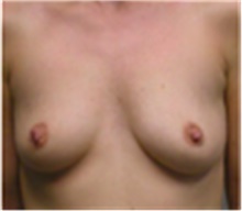 Breast Augmentation Before Photo by Mariam Awada, MD, FACS; ,  - Case 40138
