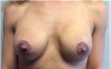 Breast Implant Removal After Photo by Mariam Awada, MD, FACS; ,  - Case 40149