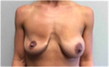 Breast Implant Removal Before Photo by Mariam Awada, MD, FACS; ,  - Case 40149