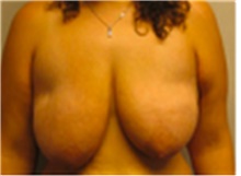 Breast Lift Before Photo by Mariam Awada, MD, FACS; ,  - Case 40154