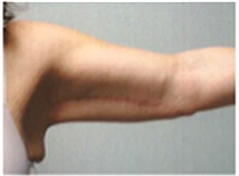Arm Lift After Photo by Mariam Awada, MD, FACS; ,  - Case 40203