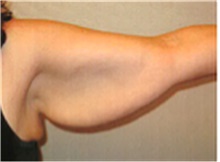 Arm Lift Before Photo by Mariam Awada, MD, FACS; ,  - Case 40203