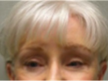 Brow Lift After Photo by Mariam Awada, MD, FACS; ,  - Case 40225
