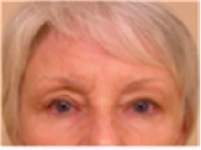 Brow Lift Before Photo by Mariam Awada, MD, FACS; ,  - Case 40225