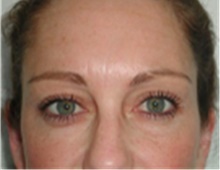 Brow Lift After Photo by Mariam Awada, MD, FACS; ,  - Case 40226