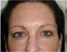 Brow Lift Before Photo by Mariam Awada, MD, FACS; ,  - Case 40226