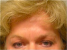 Brow Lift Before Photo by Mariam Awada, MD, FACS; ,  - Case 40227